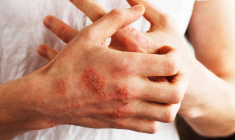 Autoimmune disorders